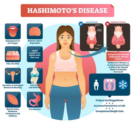 Hashimoto Prostituta